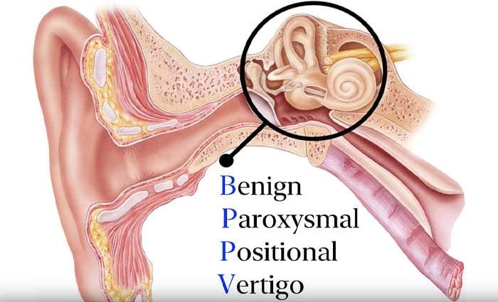 Benign Paroxysmal Positional Vertigo(BPPV) : Causes, Symptom & Solutions