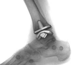 ankle specialist in Southbury CT