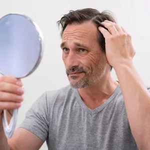 Hair Fall In Men