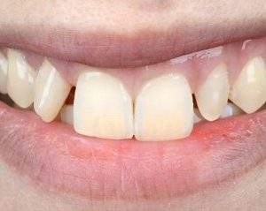 Bring Back Your Smile With Confidence