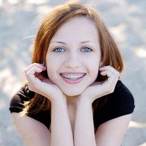 Traditional Braces