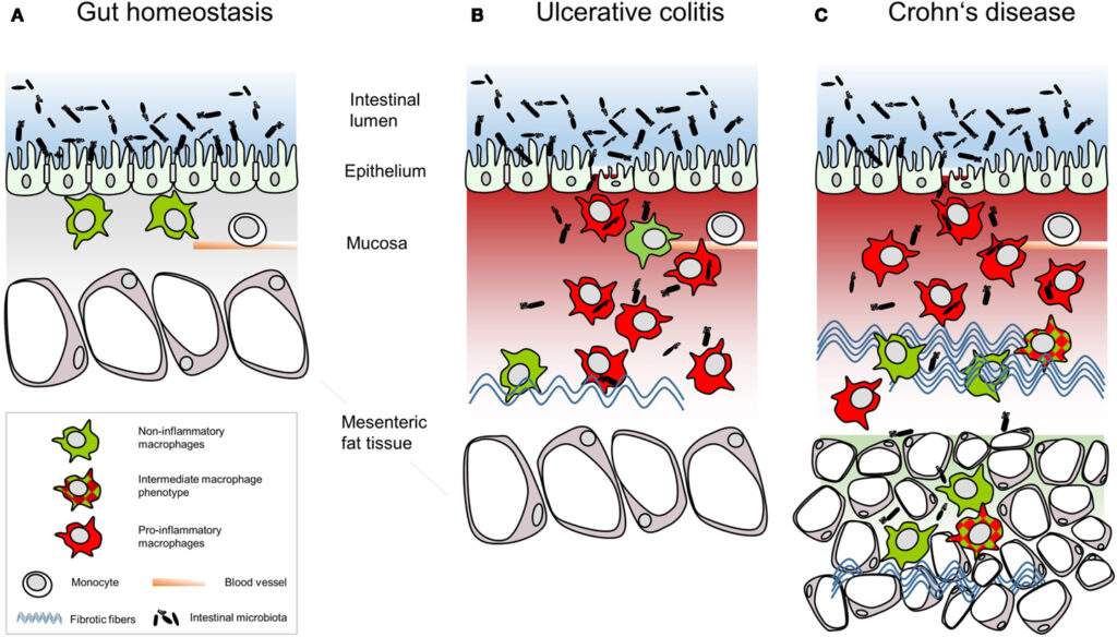 Managing Inflammatory Bowel Disease (IBD): A Comprehensive Guide to Ulcerative Colitis and Crohn’s Disease Treatment