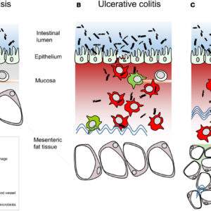 Colitis and Crohn's Disease Treatment