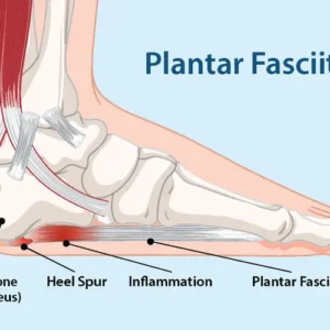 Plantar Fasciitis