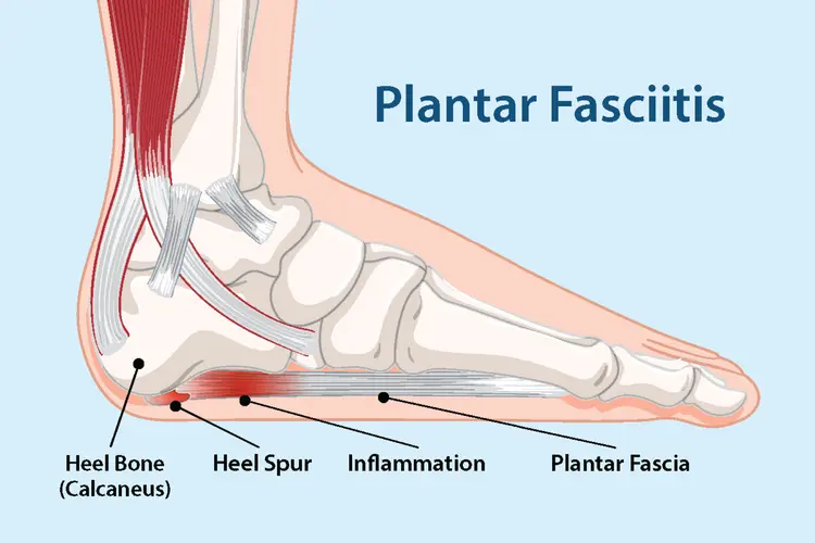 Walk Comfortably Again with Plantar Fasciitis Shoe Inserts Walk Comfortably Again with Plantar Fasciitis Shoe Inserts
